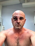 Levan Khabeishvili After Assault