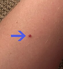 A cherry angioma on a person's arm