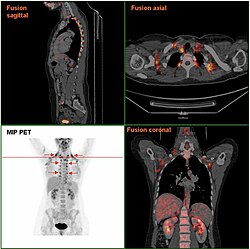 На снимке PET/CT показана бурая жировая ткань женщины