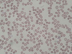 Hereditary Spherocytosis smear 2010-03-17.JPG