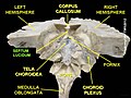 Septum pellucidum (labelled "septum lucidum") seen in a specimen from a cadaver.