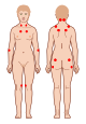 Tender points fibromyalgia.svg