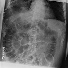 An X-ray image of the intestines, showing coiled loops that are darker on the left and right sides and lighter in the middle