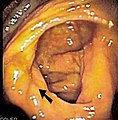 Endoscopic image of cecum with arrow pointing to ileocecal valve in foreground