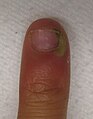 An infection of the cuticle secondary to a splinter