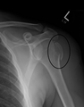 A fracture of the greater tuberosity as seen on AP X ray