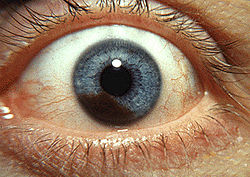 Iris melanoma