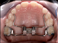 Palatal expander