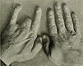 Mihran Kassabian's hands (1909)