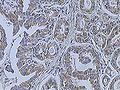 Breast cancer (Infiltrating ductal carcinoma of the breast) assayed with anti HER-2 (ErbB2) antibody.