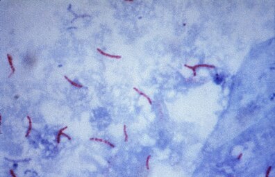 Mycobacterium tuberculosis on Ziehl-Neelsen stain