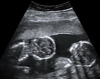 Abdominal ultrasonography of monoamniotic twins at a gestational age of 15 weeks. There is no sign of any membrane between the fetuses. A coronal plane is shown of the twin at left, and a sagittal plane of parts of the upper thorax and head is shown of the twin at right.