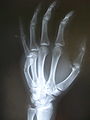 Fracture of the fifth metacarpal (boxer's fracture).