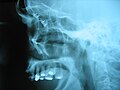 人間の頭蓋骨のX線写真。骨折を治療するために、眼窩の部分にチタン製のプレートとネジが埋め込まれている。