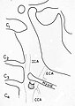 Линия, изображающая панорамную рентгенограмму с овоидной атеромой в области бифуркации общей сонной артерии (CCA), когда она раздваивается (делится) в шее на внутреннюю сонную артерию (ICA), которая снабжает кровью головной мозг и наружную сонную артерию (ECA), которая снабжает кровью лицо и рот.