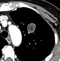 Low attenuating nodule (in this case a fat containing hamartoma).[9]