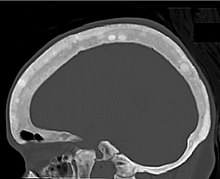 CT shows focal areas of osteosclerosis.[18]