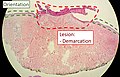 2 - Orientation: In this case oriented by the skin surface (green). A lesion is seen (red) and its delimitation can be discerned (diffuse in this case)