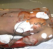 Crime scene photograph of Rainey’s body in the prison infirmary right after his death. The white patches are material that staff used in efforts to revive him.