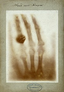 First medical X-ray, at and by Wilhelm Röntgen (restored by Yann)