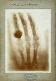 First medical X-ray