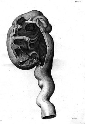 Image illustrative de l’article Néphrite (médecine)