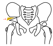 Schritt 3 – Interposition des Knochenkeiles