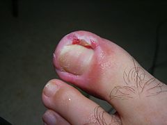 Toenail that had wedge resections on both sides but soon failed on one side