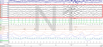 Stage N1 Sleep. EEG highlighted by red box.