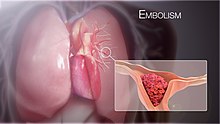 3D Medical Animation still shot showing Pulmonary Embolism
