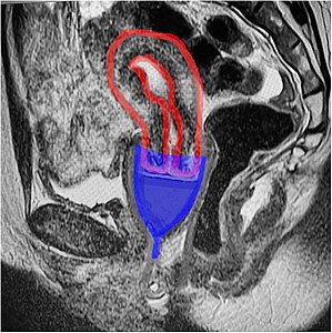 An MRI showing a bell-shaped menstrual cup in place; cup in blue, uterus in red. The ectocervix (the portion of the cervix that protrudes into the vagina) sits inside the cup. Sagittal plane.