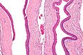 Intermediate magnification of an odontogenic keratocyst showing a folded cyst.