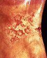 Erythroleukoplakia in left commissure and buccal mucosa. Biopsy showed mild epithelial dysplasia and presence of candida infection. A 2-3 week course of anti-fungal treatment may turn this type of lesion into a homogenous leukoplakia.