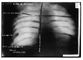 Radiographie de la balle de Schrank dans la poitrine de Roosevelt.