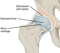 Annotated illustration of hip joint with ostoarthritis