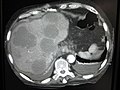 Multiple liver metastases.