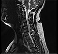 MRI scan of cervical disc herniation between C6 and C7 vertebrae