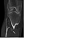 CT of osteochondroma in MO