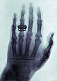 X-ray by Wilhelm Röntgen