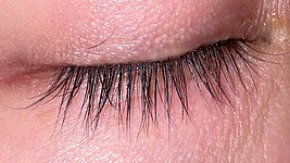 Eyelashes that are excessively long (12mm or longer), thick, and prominent are a finding of trichomegaly