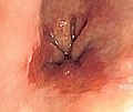 Endoscopic image of Barrett esophagus – a frequent precursor of esophageal adenocarcinoma
