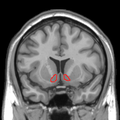 MRI coronal slice showing nucleus accumbens outlined in red