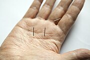 Sujichim, hand acupuncture