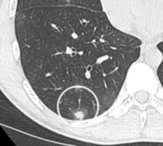 subpleural nodule.[9]