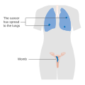 Stage 3 choriocarcinoma