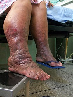 Lymphedema.jpg