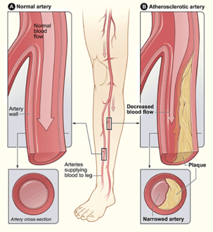 Illustration of atherosclerosis causing arterial obstruction which clinically presents at peripheral artery disease.