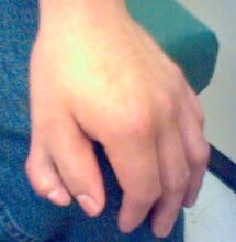 Male with unilateral preaxial polydactyly affecting the left thumb. The supernumerary digit had normal sensation but no joint and hence could not move independently.