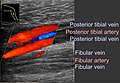 Coronal plane (seen from medial side of lower leg) ultrasonography of deep vein thrombosis of the fibular veins, seen as hyperechoic content and only marginal blood flow.