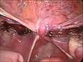 End of a laparoscopical hysterectomy